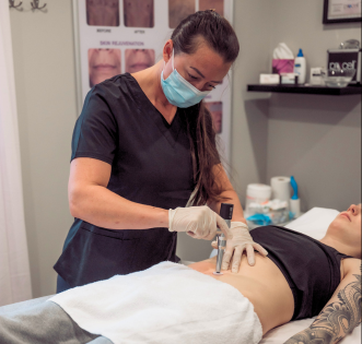 A female client receiving a Microchanneling treatment on her stomach for stretch marks.